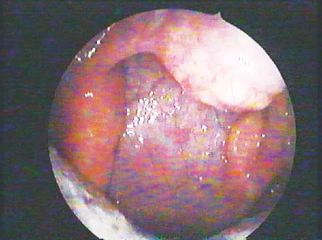 Depozita amyloidu v laterálních stěnách orofaryngu a na zadní ploše uvuly.