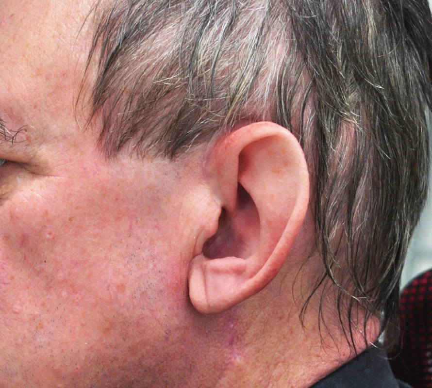 Pacient s melanomem ušního boltce – po zhojení s epitézou.
