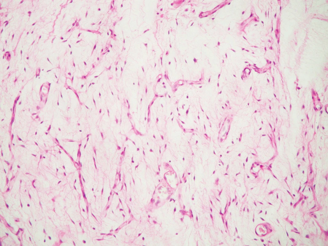 Histologický obraz myxoidního liposarkomu hrtanu.