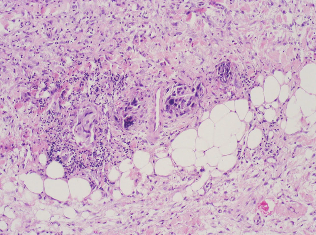 Nespecifická granulační a tuková tkáň v okolí VJI se skupinami nádorových buněk (hematoxylin-eosin, zv. 100x).