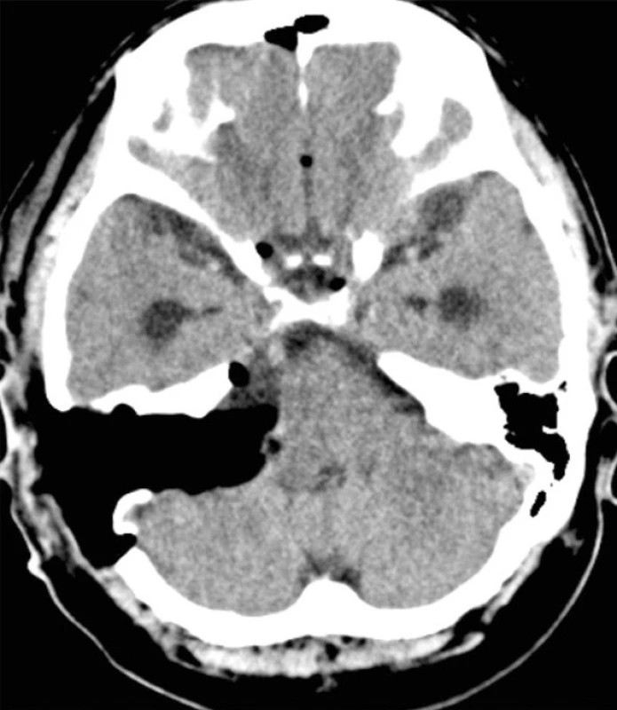 CT nález u toho istého pacienta na 3. pooperačný deň ukazuje rozsah trepanácie a úplnú exstirpáciu tumoru.