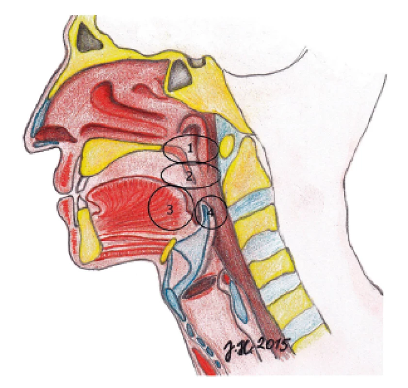 Čtyři hodnocená místa obstrukce v HDC dle Keziriana. 1 – měkké patro, 2 – laterální stěny hltanu, tonzily, 3 – kořen jazyka, 4 – epiglotis.