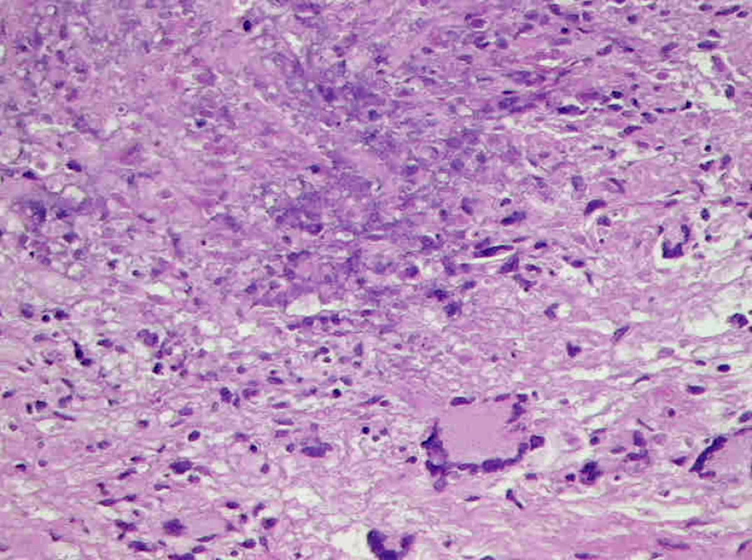 Nekrotizující granulom s obrovskými mnohojadernými buňkami. Nekróza je patrná v horní části obrázku.