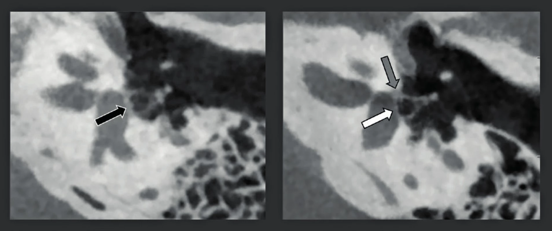 CBCT zdvojená šikmá rekonstrukce snímků středního ucha s vysokým rozlišením (rozlišení 150 μm) u dvou rozdílných pacientů s otosklerózou.