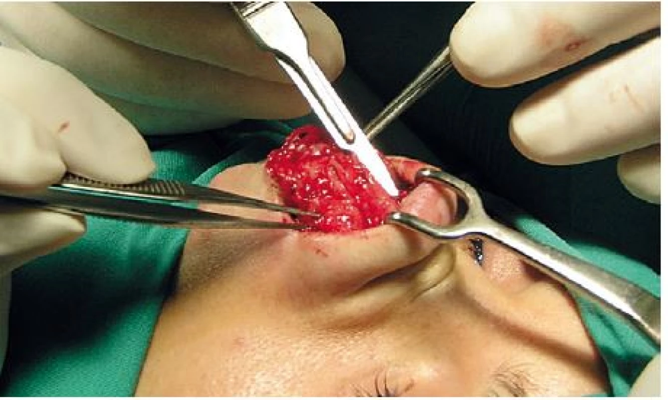 Zrezanie prominujúceho dorza – spojenia laterálnych chrupiek a septálnej chrupky skalpelom pod kontrolou zraku z otvoreného prístupu.