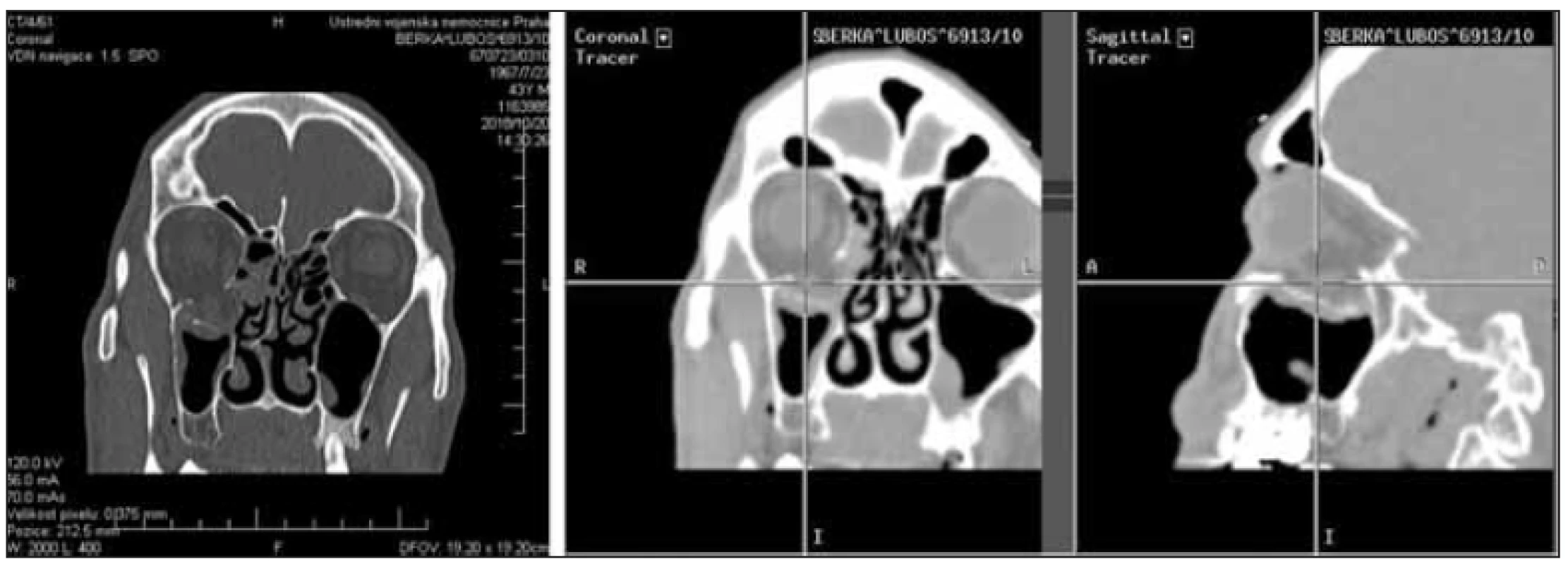 Využití CT navigace k ověření správné mobilizaci a fixace zlomeniny spodiny očnice (transantrální přístup, vzpěra).