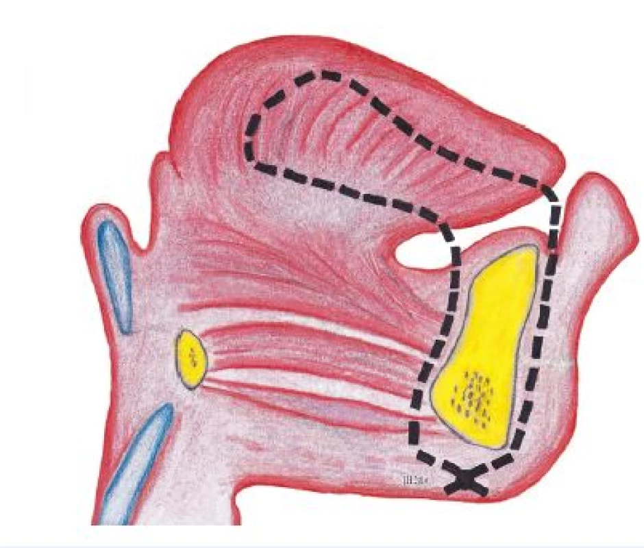 Fixace jazyka kolem dolní čelisti s vyvedením stehu submentálně do podkoží.