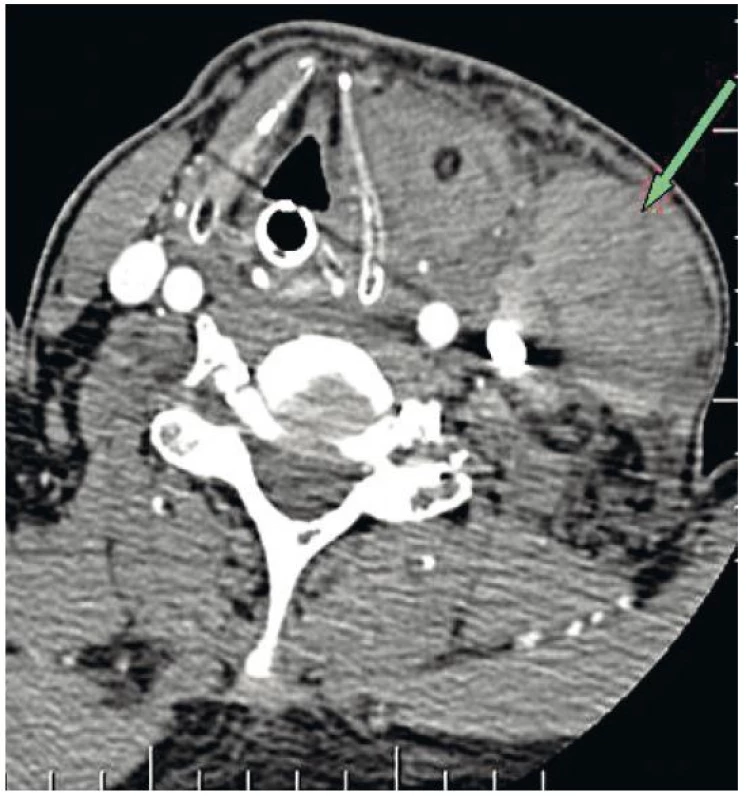 CT zobrazení v axiální projekci masivního hematomu u zaintubovaného pacienta s dislokací a. carotis, uzávěrem v. jugularis interna a útlakem hrtanu.