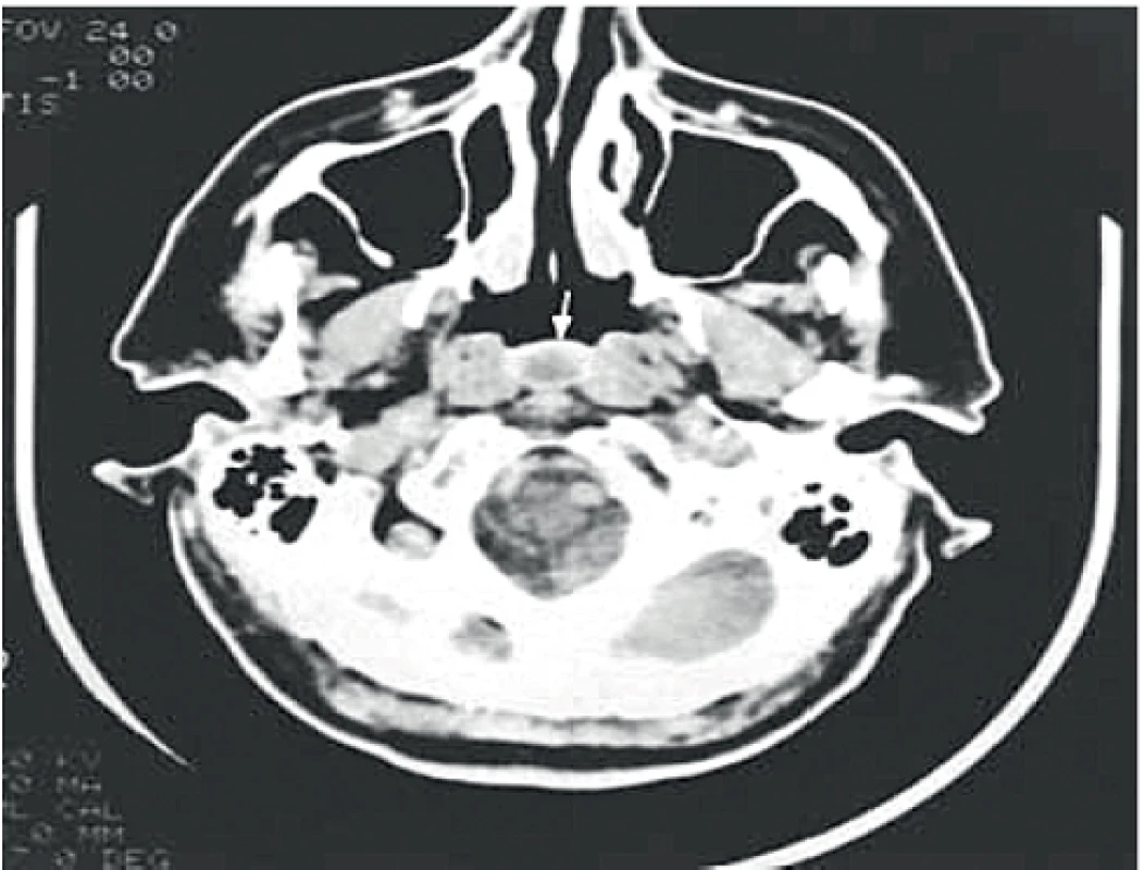 Natívne CT – transverzálna projekcia. Tornwaldtova cysta označená šípkou.