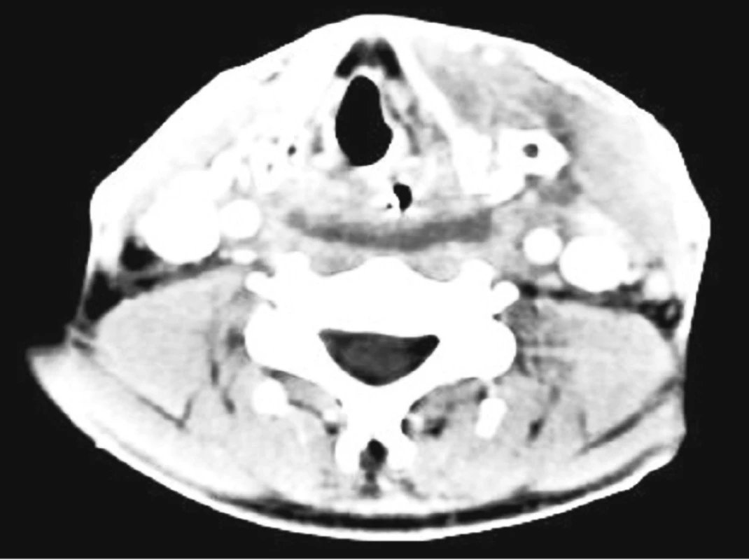 Horizontální CT s kontrastem na úrovni štítné chrupavky – patrná drenáž parafaryngeálního abscesu ventrálně od velkých cév, prevertebrálně (dorzálně od zavedené NG sondy) přetrvávající kolekce hnisu s pyogenní membránou