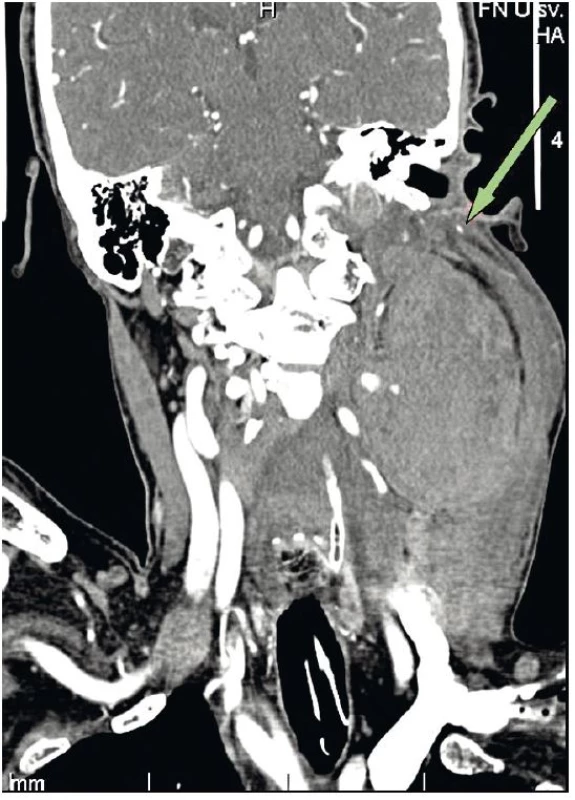 CT zobrazení v koronární projekci masivního hematomu u zaintubovaného pacienta s dislokací a. carotis, uzávěrem v. jugularis interna a útlakem hrtanu.