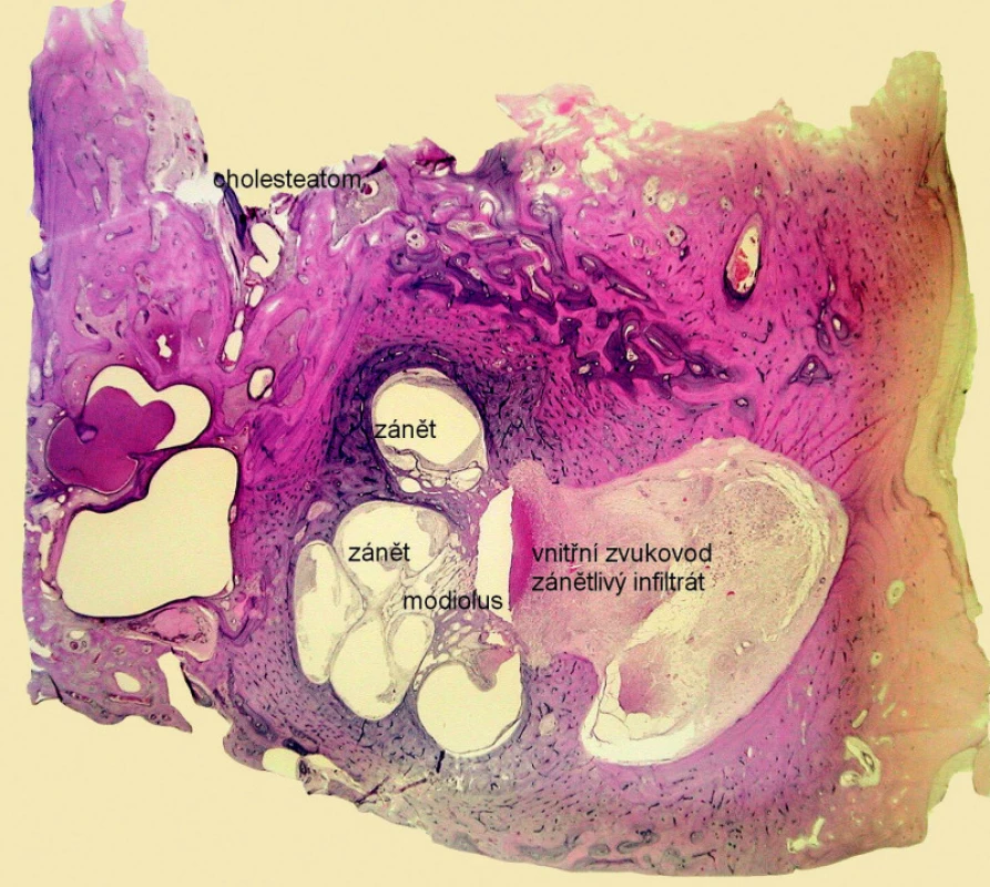 Akutní hnisavá labyrintitida – zánětlivý infiltrát v oblasti hlemýždě a vnitřního zvukovodu. Kazuistika 2. - histologický obraz, vertikální řez levou spánkovou kostí, barvení hematoxylin eozin.