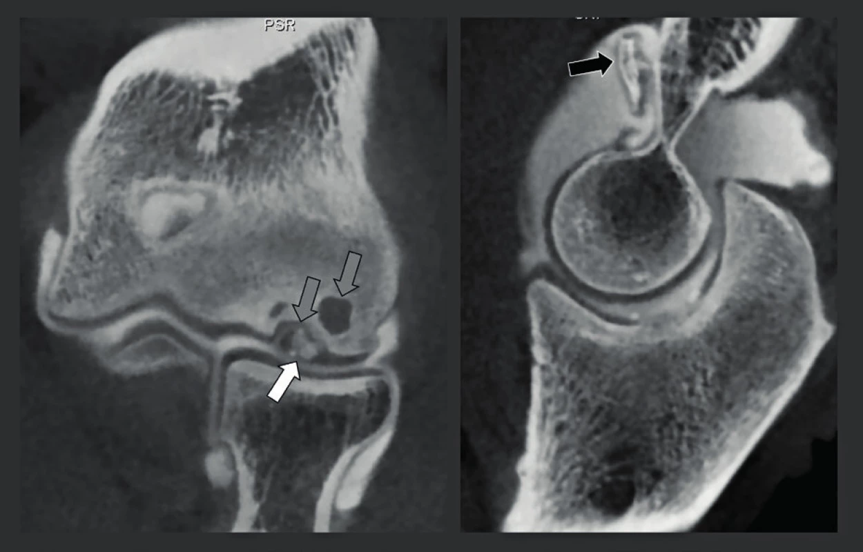 CBCT-artrografie u pacienta s osteochondritis dissecans lokte.