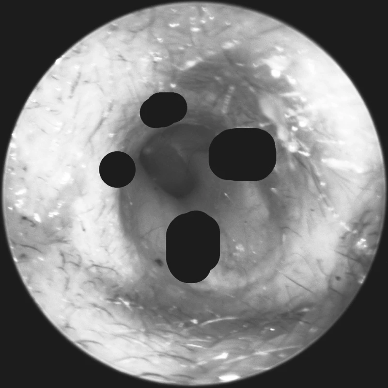 Pohled do levého zvukovodu. Vyznačeny jsou oblasti přední, horní a dolní stěny, ve kterých byl zvukovod palpován při sledování incidence Arnoldova reflexu.