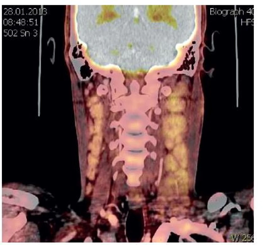 PET CT - zvětšené lymfatické uzliny na krku a periklavikulárně vlevo, vpravo laterálně jen s mírnou metabolickou aktivitou.