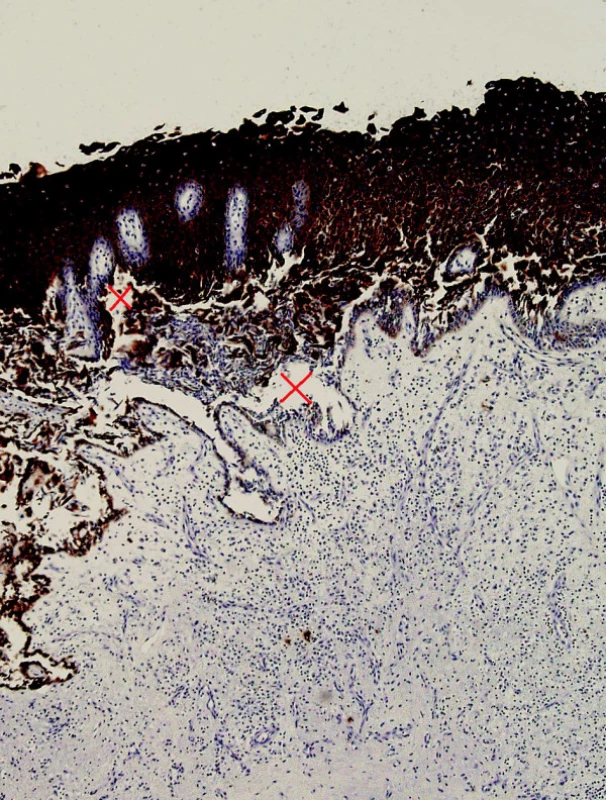 Histologický řez intradermální buly. Barvení na cytochromatin, zvětšeno 100x, křížkem označena místa epidermální akyntolýzy.