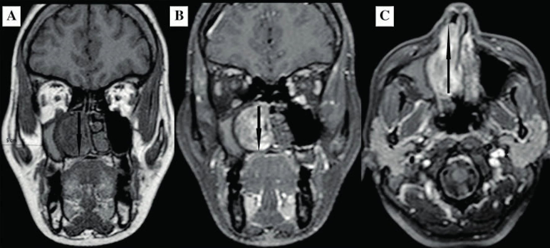 MRI – PND: A – T1A koronálna, B – T1A koronálna s kontrastom, C – T1A axiálna s kontrastom.