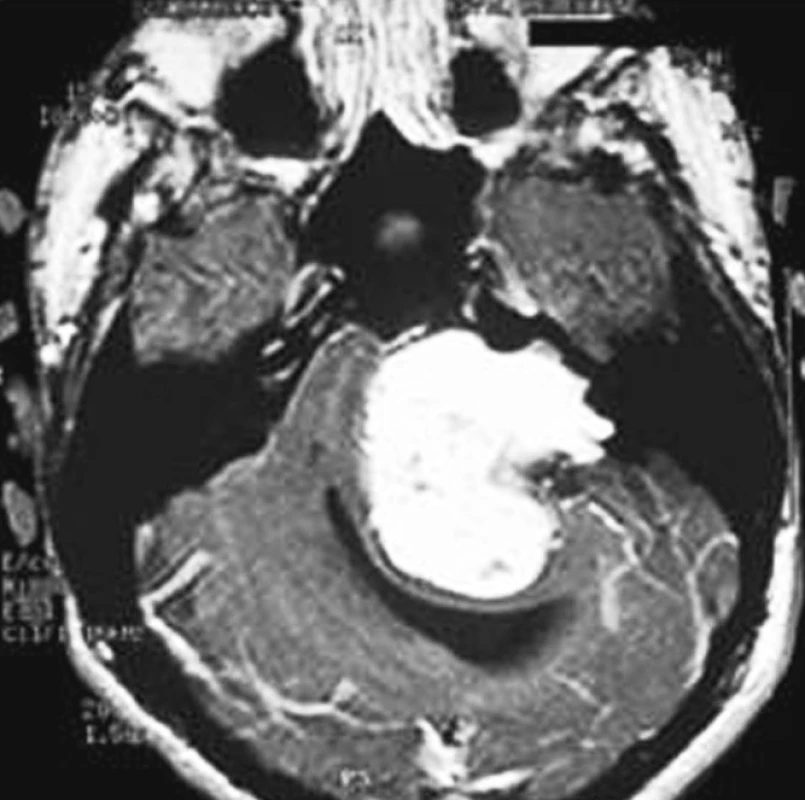 Gigantický tumor vyplňující mostomozečkový kout vlevo, výrazně komprimující a dislokující mozkový kmen a mozeček s defigurací a rozšířením IV. mozkové komory (4b. stupně, klinicky se známkami nitrolební hypertenze). Tumor rozsáhle rozšiřuje vnitřní zvukovod a destruuje přilehlou pyramidu (T1SE + Gadolinium).