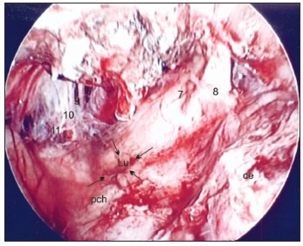 Translabyrintná endoskopia po odstránení meningeomu veľkosti 3,5 cm vľavo.
Legenda: ce – cerebellum, pch – plexus chorioideus, Lu – foramen Luschkae, 8 – n. cochleovestibularis, 7 – n. facialis, 9 – n. glossopharyngeus, 10 – n. vagus, 11 – n. accessorius
Šípky ukazujú na foramen Luschkae.