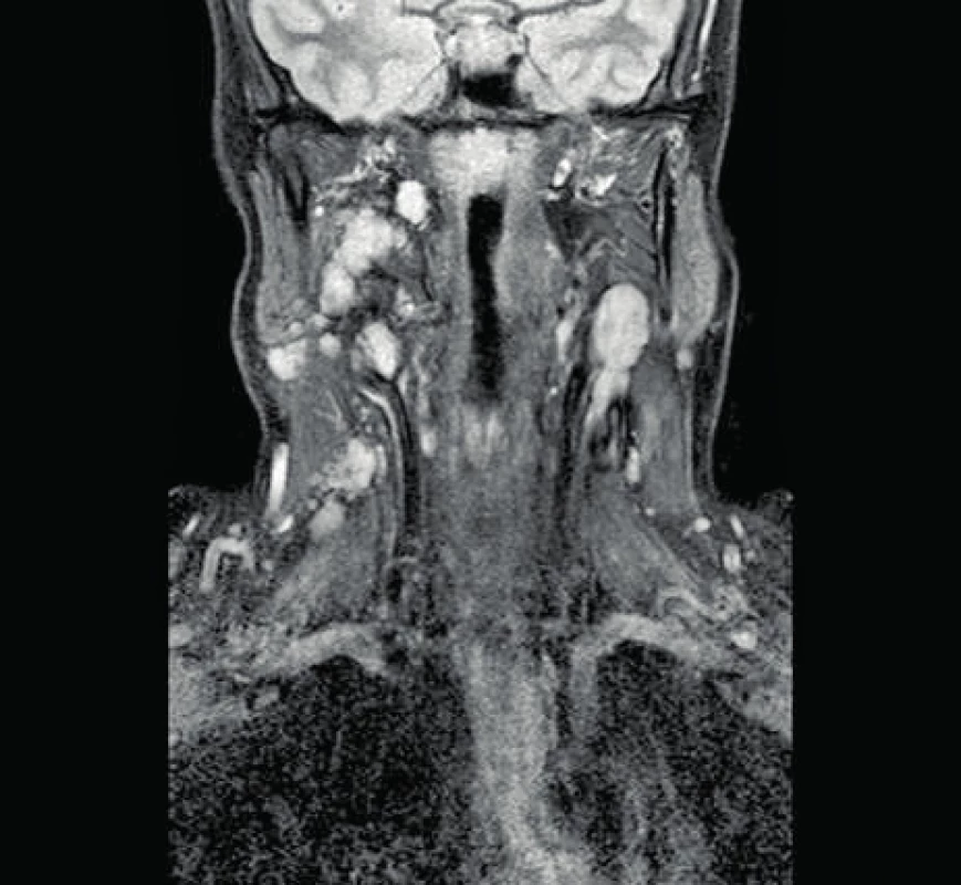 MRI zobrazenie - agresívna mnohopočetná recidíva pleomorfného adenómu (šípky).