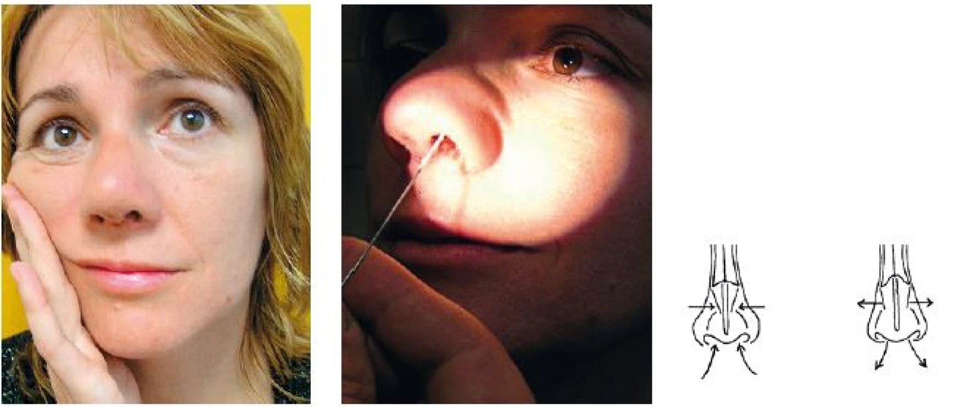 Vľavo: Cottleho príznak – pri natiahnutí líca sa zlepší dýchanie cez nos na rovnakej strane nosovej dutiny. V strede: diagnostika obštrukcie v oblasti nosovej chlopne vľavo.  Vpravo: princíp obturácie v oblasti nosovej chlopne pri dýchaní. Pôsobí ako ventil, ktorý sa v inspíriu nasáva.