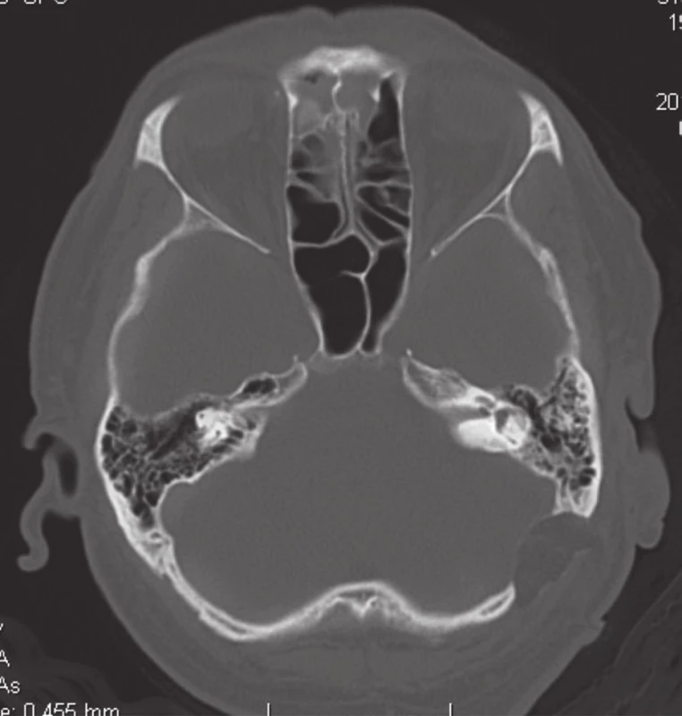 Natívne CT – axiálna projekcia. Stav po sekcii n. vestibuláris vľavo retrosigmoidovým prístupom. Obliterácia kosteného defektu tukom.