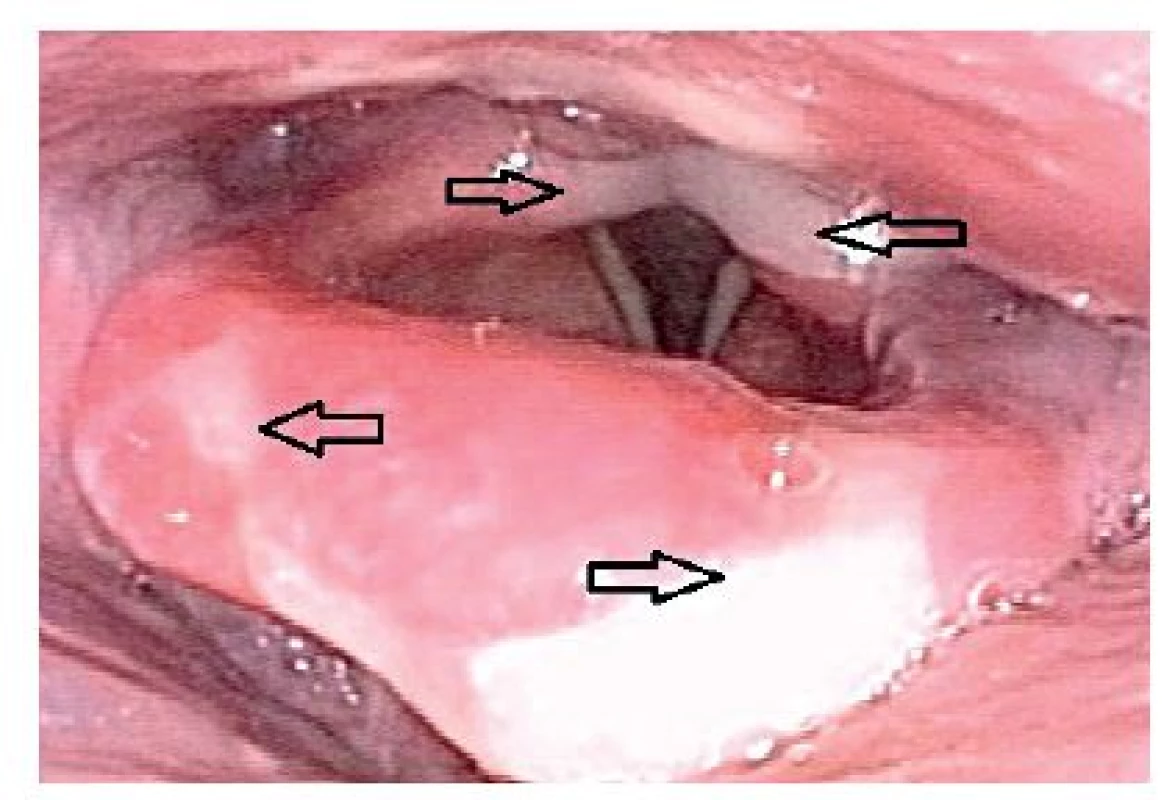 Bělavé povlaky (šipky) na epiglotis a arytenoidních hrbolech (zvětšovací laryngoskopie)