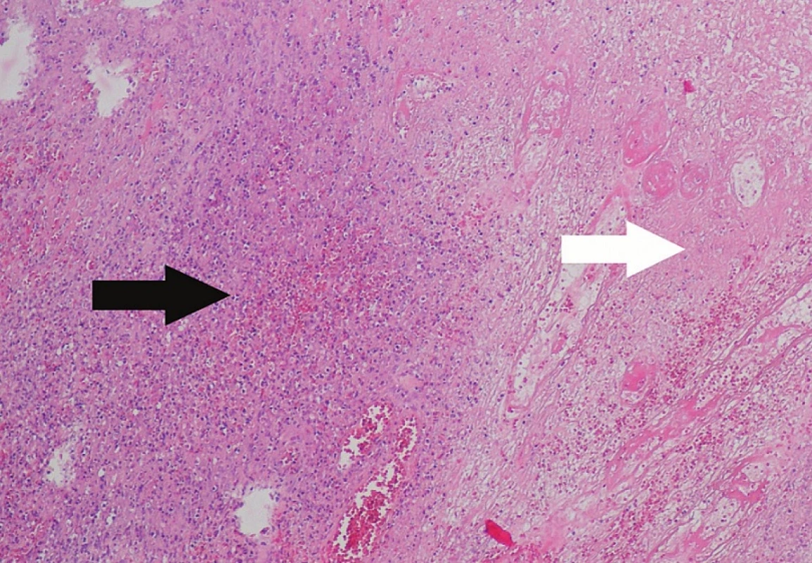 Přehledný histologický preparát, na kterém jsou zastiženy měkké tkáně prostoupené difuzně rostoucí populaci středně velkých lymfoidních elementů, často s angulovaným či konvolutovaným jádrem a světlou cytoplazmou (černá šipka), dále jsou patrné nekrotické oblasti v nádorové mase (bílá šipka) (barveni Hematoxylin&amp;Eosin, zvětšení 100krát).