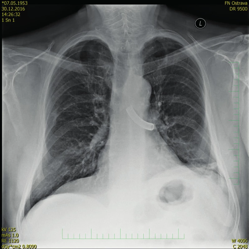 Rentgenový snímek plic; kovová kanyla v levém hlavním bronchu.