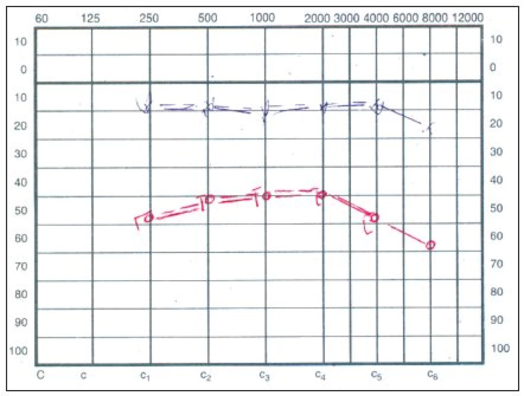 Audiogram – náhla percepčná kochleárna porucha sluchu vpravo.