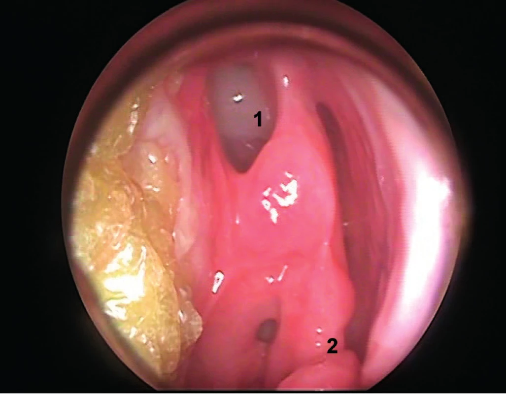 Rinoendoskopický pohľad rok od operácie, č. 1 - miesto duroplastiky, č. 2 - časť resekovanej strednej nosovej mušle.