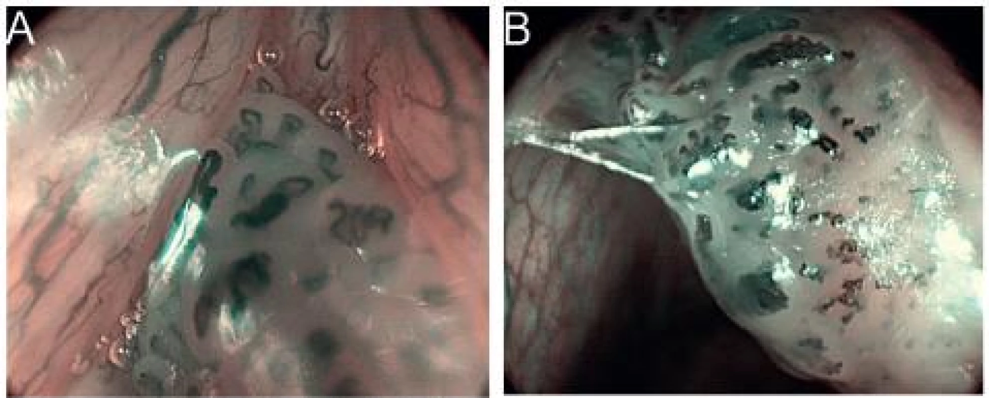 Papilom hlasivky, HDTV NBI zvětšovací endoskopie (A, B). Patrné jsou mnohočetné pravidelné papily, kryté dlaždicovým epitelem, s centrální kapilární kličkou, které jsou typické pro papilomy.