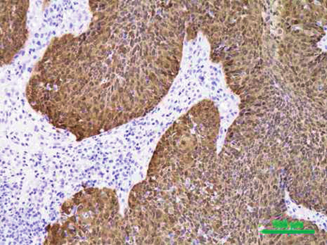 Imunohistochemicky p16 pozitivní (hnědé zbarvení) dlaždicový karcinom, původní zvětšení 200x (PAÚ FN u svaté Anny, Brno).