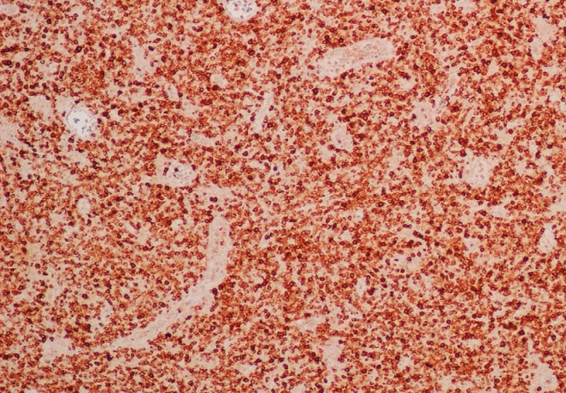 Většina nádorových buněčných elementů silně pozitivní při průkazu T markeru (CD3) (hnědá barva) (zvětšení 100krát). Jedná se o imunohistochemické vyšetření.