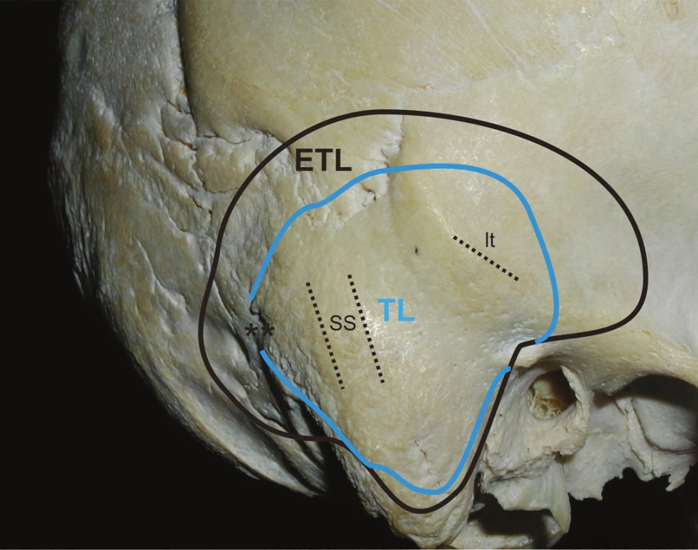 Lebka – pravá strana. Pohľad zboku pravú na spánkovú kosť a jej sutúry s okcipitálnou a parietálnou kosťou.