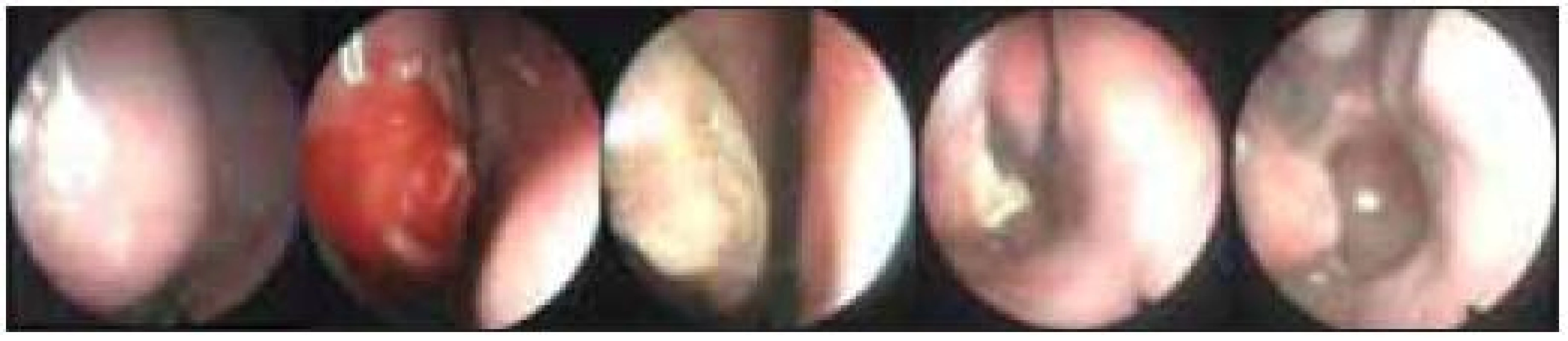Dokumentace pooperačního hojení a efektu laserového zákroku na dolní skořepě vpravo; zcela vlevo stav před operací, zcela vpravo stav 3 měsíce po operaci. 