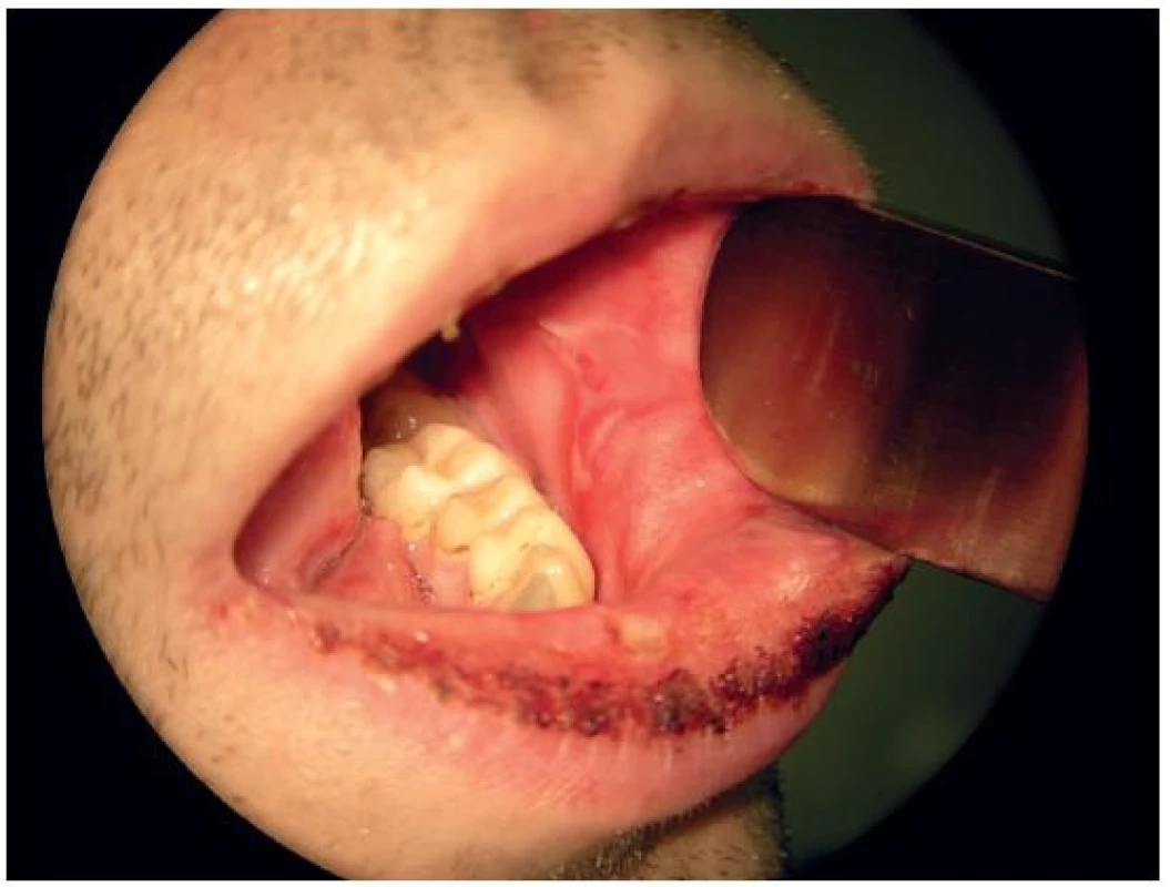 Stav ústní sliznice po 10 dnech od přijetí k hospitalizaci.