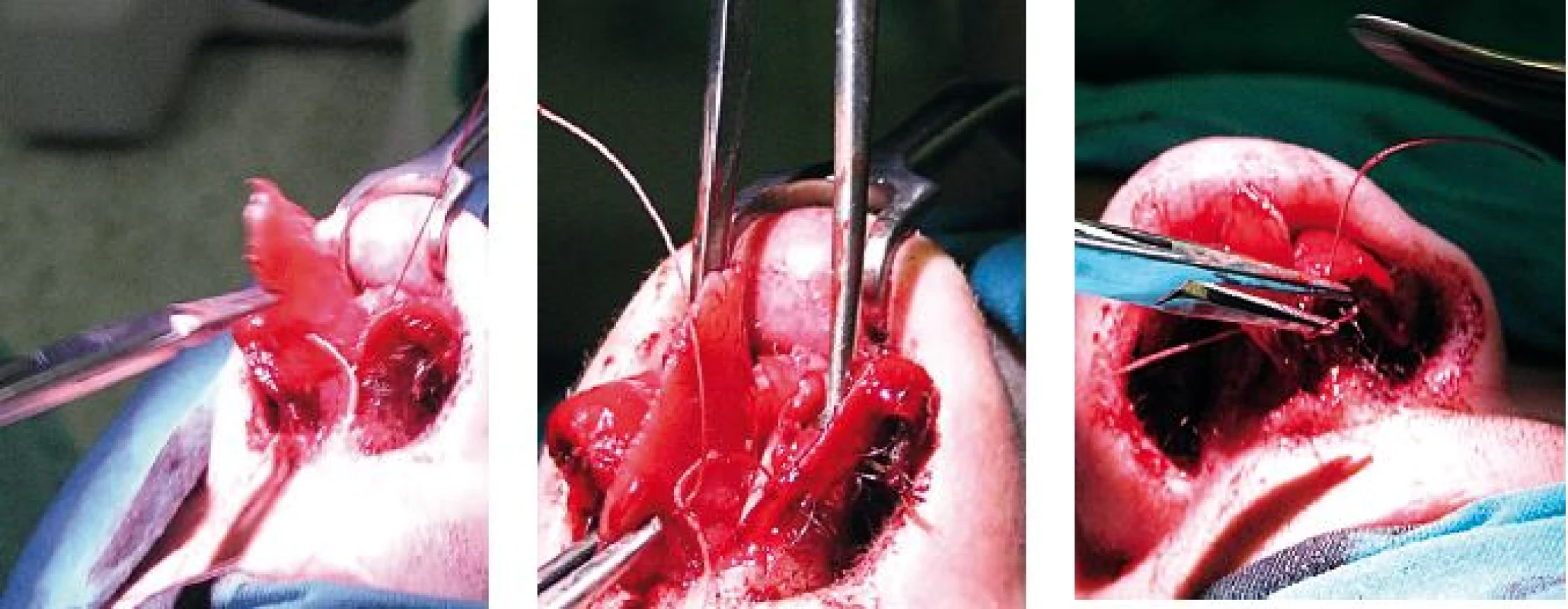 Vľavo: chrupka priehradky vybratá von z nosa. V strede: rovná platnička vložená naspäť a fixovaná k spodine pri spina nasalis anterior. Vpravo: fixácia dómov cez platničku septálnej chrupky.