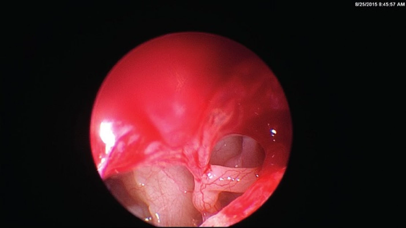 Pacient MS, 9 let, levé ucho. Velmi dobře endoskopicky vizualizovaná trakční retrakce 2. stupně dle Sadé.