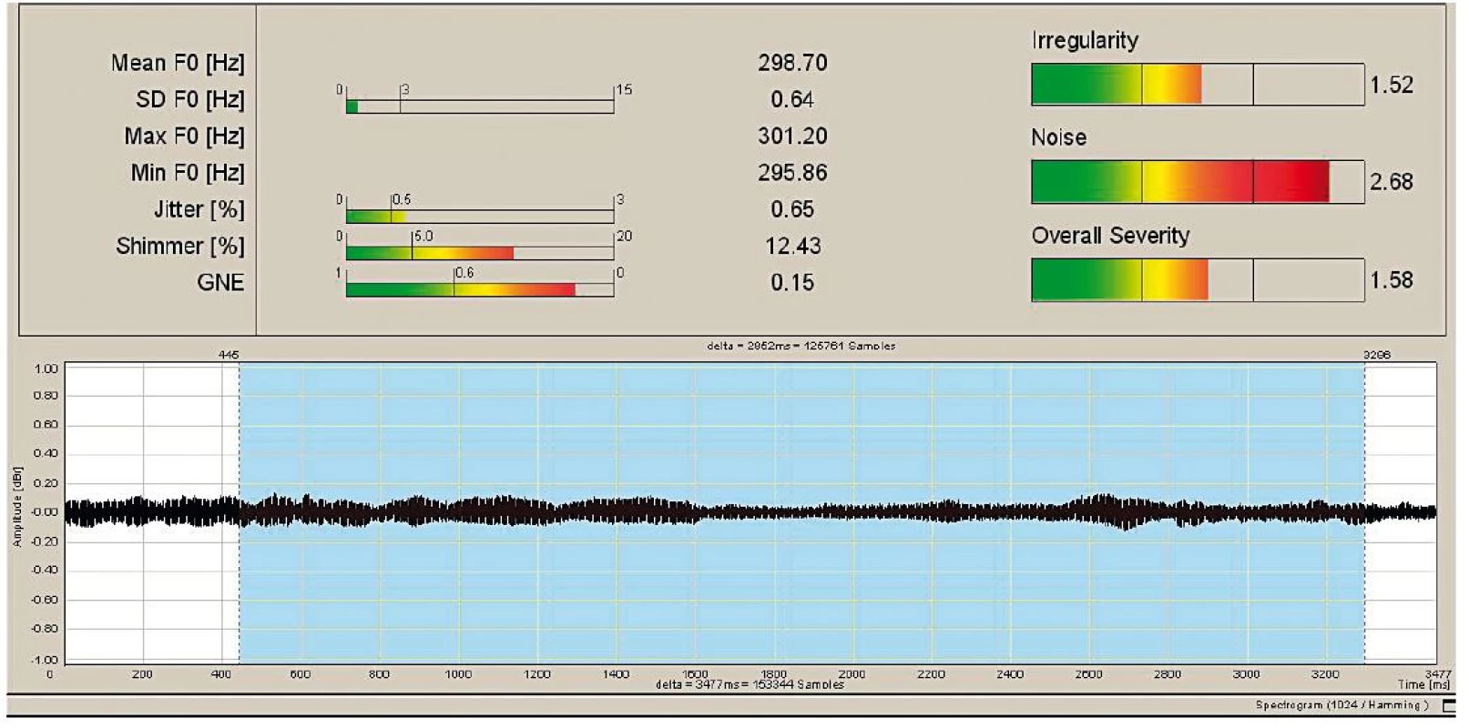 Analýza Vospector v programu Lingwaves, předoperační záznam pacientky č. 2.