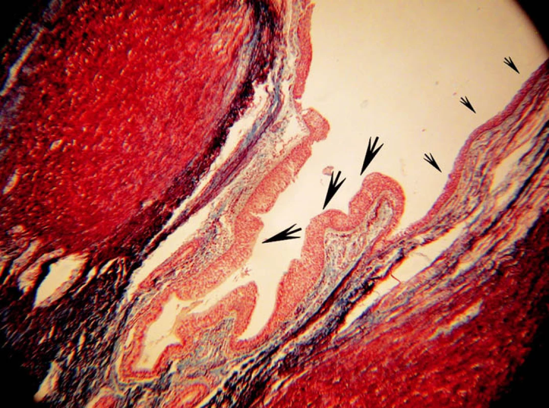 Přechod rohovatějícího dlaždicového epitelu hrany hlasové řasy (malé šipky) v respirační epitel (velké šipky) v oblasti přední komisury glottis.
