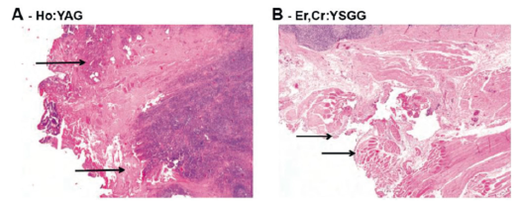 Histologické vyšetření tkáně po tonzilektomii Ho:YAG a Er,Cr:YSGG.