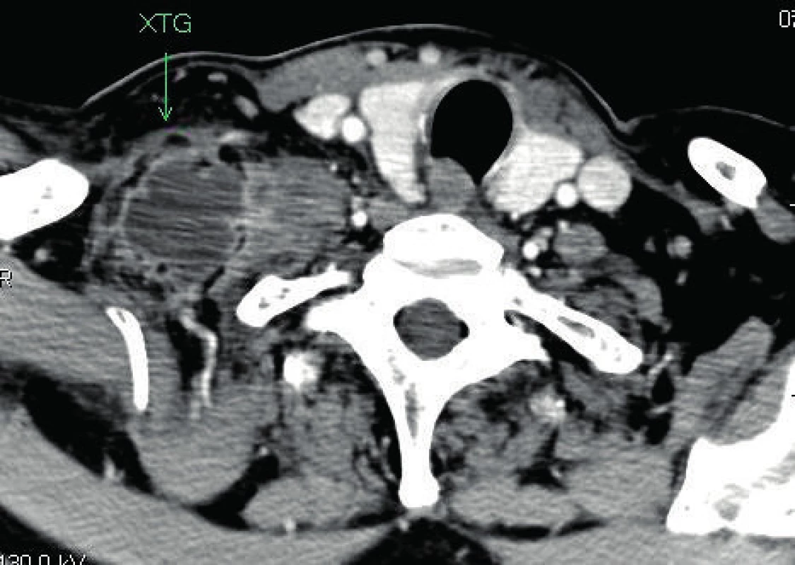 CT zobrazení xantogranulomu (XTG) pravého nadklíčku, axiální řez.