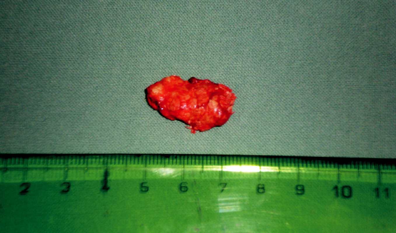 Odstraněný kožní tumor velikosti přes 2 cm, tuhé kozistence, nerovných okrajů.