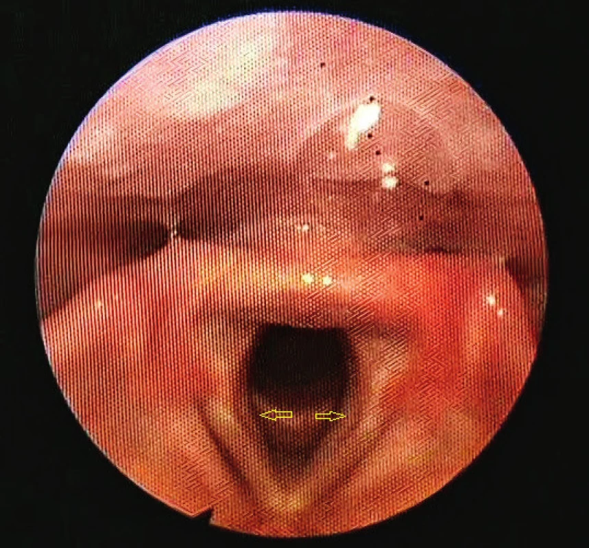 Pseudosulucs vocalis, začervenanie arytenoidov.