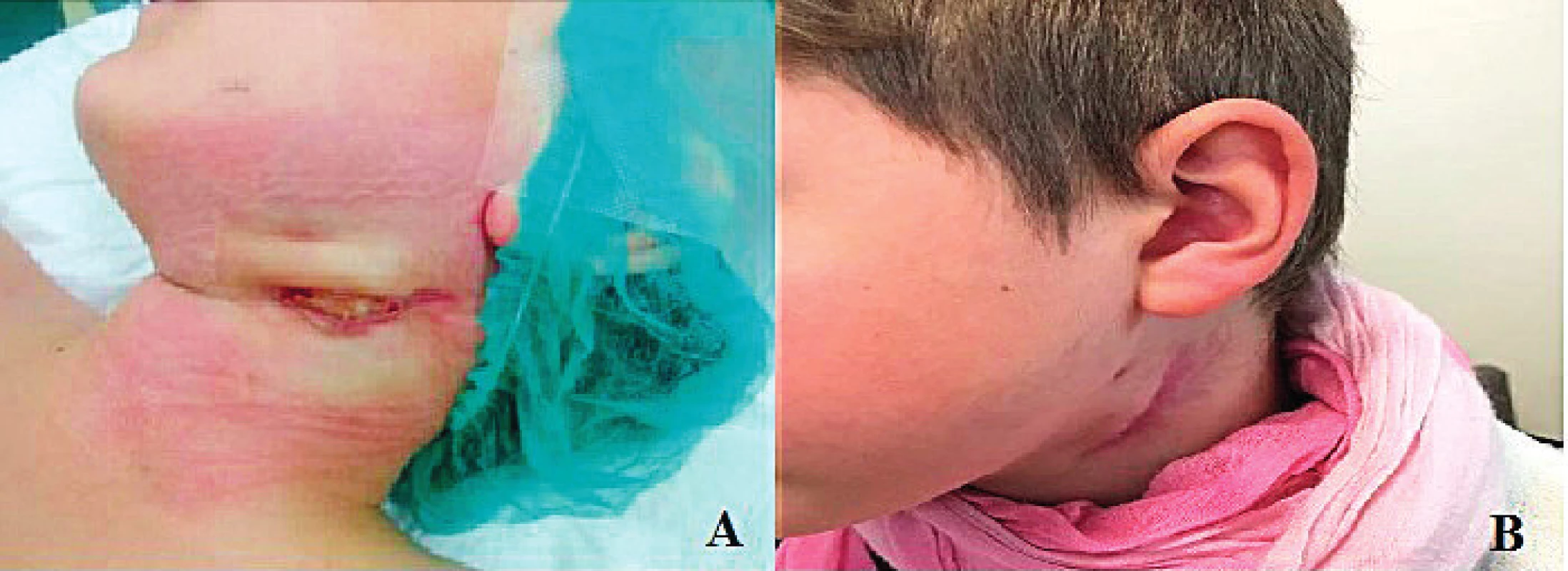 Nález pred (A) a po (B) tretej reoperácii
pre dehiscentnú ranu na krku.