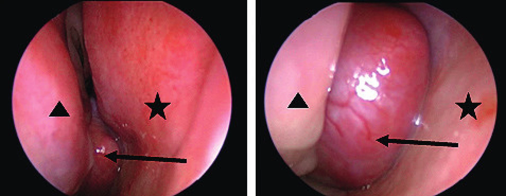 Endoskopický pohled na JNA.
šipka – tumor, hvězdička – septum, trojúhelník – dolní skořepa