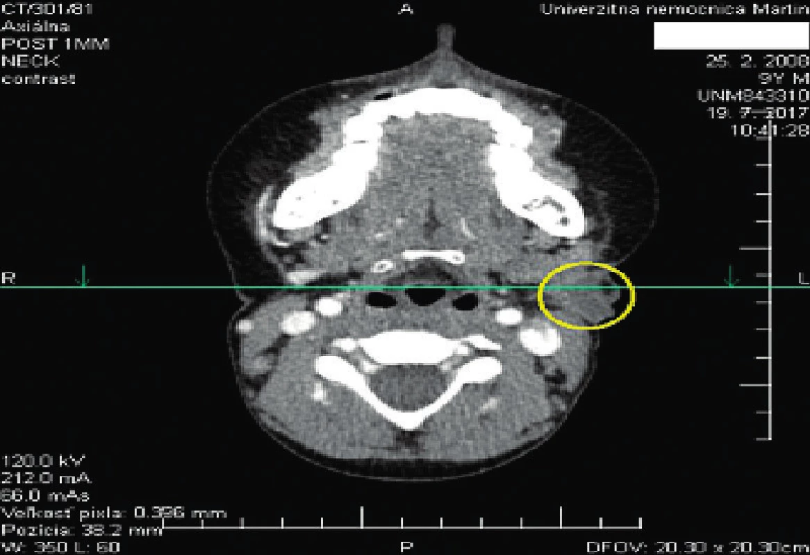 CT obraz skolikvovaných lymfatických uzlin.