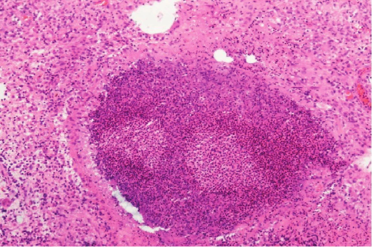 Granulóm s centrálnou infiltráciou leukocytmi
v lymfatickej uzline u pacienta s chronickou granulómovou
chorobou. Hematoxylín-eozín, zv. 100 x.
