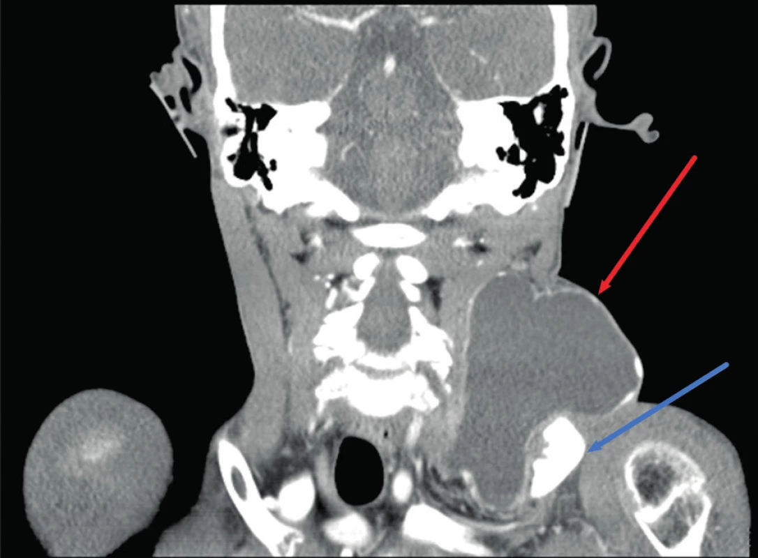 Cysta ductus thoracicus. Kontrastní CT krku, koronální
rovina. Patrné šíření cysty (červená šipka) pod klíček (modrá šipka).